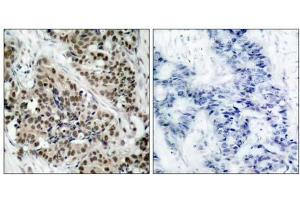 Immunohistochemical analysis of paraffin- embedded human breast carcinoma tissue using FKHR (phospho-Ser256) antibody (E011115). (FOXO1 anticorps  (pSer256))