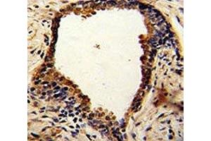 IHC analysis of FFPE human prostate carcinoma with NDRG1 antibody