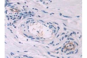 Detection of ENG in Human Lung cancer Tissue using Polyclonal Antibody to Endoglin (ENG)
