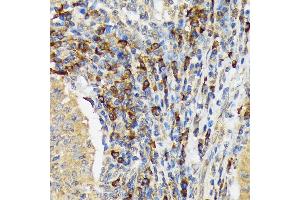 Immunohistochemistry of paraffin-embedded human esophageal cancer using V Rabbit mAb (ABIN7271305) at dilution of 1:100 (40x lens).
