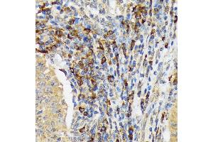 Immunohistochemistry of paraffin-embedded human esophageal cancer using V Rabbit mAb (ABIN7271305) at dilution of 1:100 (40x lens). (VAV3 anticorps)