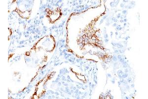 Formalin-fixed, paraffin-embedded human Lung SCC stained with Cytokeratin 7 Mouse Monoclonal Antibody (K72. (Cytokeratin 7 anticorps)