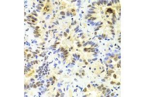 Immunohistochemistry of paraffin-embedded human lung cancer using SRSF1 Antibody.
