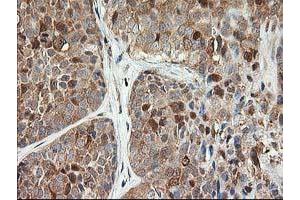 Immunohistochemical staining of paraffin-embedded Adenocarcinoma of Human breast tissue using anti-LSM1 mouse monoclonal antibody. (LSM1 anticorps)