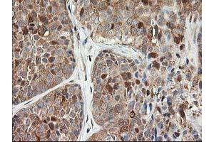 Immunohistochemical staining of paraffin-embedded Adenocarcinoma of Human breast tissue using anti-LSM1 mouse monoclonal antibody. (LSM1 anticorps)