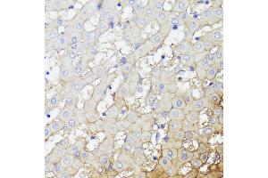 Immunohistochemistry of paraffin-embedded Human liver cancer using CD276/B7-H3 antibody (ABIN7266182) at dilution of 1:100 (40x lens).