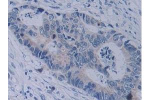 Detection of NRP2 in Human Colorectal cancer Tissue using Polyclonal Antibody to Neuropilin 2 (NRP2)