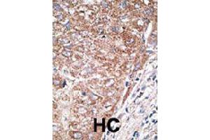 Formalin-fixed and paraffin-embedded human hepatocellular carcinoma tissue reacted with NEUROD1 polyclonal antibody  , which was peroxidase-conjugated to the secondary antibody, followed by DAB staining. (NEUROD1 anticorps  (N-Term))