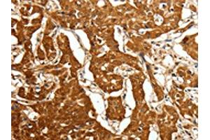 The image on the left is immunohistochemistry of paraffin-embedded Human lung cancer tissue using ABIN7128859(CDH23 Antibody) at dilution 1/80, on the right is treated with fusion protein. (CDH23 anticorps)