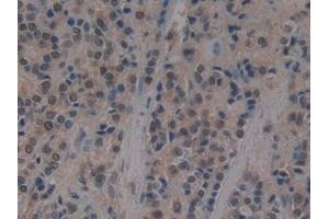 Detection of UBE1L in Human Prostate cancer Tissue using Polyclonal Antibody to Ubiquitin Activating Enzyme E1 Like Protein (UBE1L) (UBA7 anticorps  (AA 429-488))