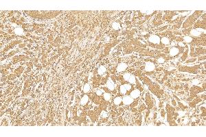 Detection of CK18 in Human Breast cancer Tissue using Monoclonal Antibody to Cytokeratin 18 (CK18)