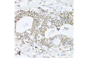 Immunohistochemistry of paraffin-embedded human gastric cancer using ATP1B1 antibody (ABIN5973412) at dilution of 1/100 (40x lens). (ATP1B1 anticorps)