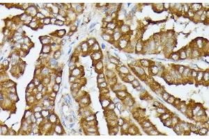 Immunohistochemistry of paraffin-embedded Human thyroid cancer using COX15 Polyclonal Antibody at dilution of 1:100 (40x lens).