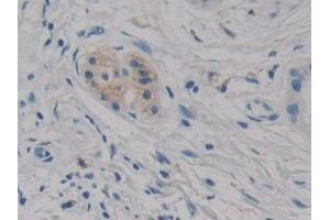 Detection of CIDEC in Human Pancreatic cancer Tissue using Polyclonal Antibody to Cell Death Inducing DFFA Like Effector C (CIDEC)