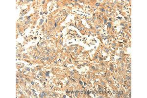 Immunohistochemistry of Human lung cancer using AGRN Polyclonal Antibody at dilution of 1:30 (AGRN anticorps)