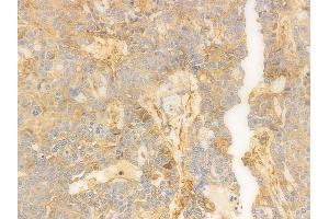 ABIN6259956 and ABIN6276843 at 1/100 staining human ovarian carcinoma by IHC-P. (Annexin V anticorps  (C-Term))