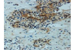 Immunohistochemistry of paraffin-embedded human cervical carcinoma using MMP1 antibody. (MMP1 anticorps  (AA 20-280))