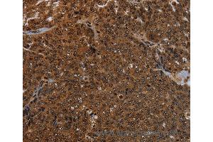 Immunohistochemistry of Human cervical cancer using KDM4B Polyclonal Antibody at dilution of 1:50 (KDM4B anticorps)