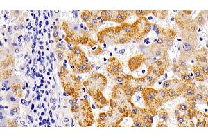 Detection of LAMP1 in Human liver cirrhosis Tissue using Polyclonal Antibody to Lysosomal Associated Membrane Protein 1 (LAMP1) (LAMP1 anticorps  (AA 49-297))