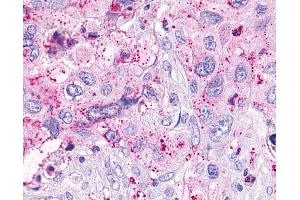 Anti-OXER1 antibody IHC of human Pancreas, Carcinoma. (OXER1 anticorps  (C-Term))