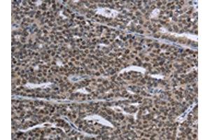 The image on the left is immunohistochemistry of paraffin-embedded Human ovarian cancer tissue using ABIN7191353(MAGEC1 Antibody) at dilution 1/30, on the right is treated with synthetic peptide. (MAGEC1 anticorps)