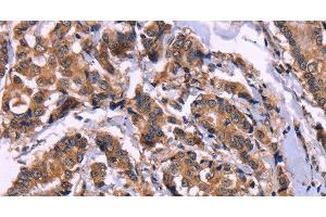 Immunohistochemistry of paraffin-embedded Human breast cancer using AMIGO2 Polyclonal Antibody at dilution of 1:50 (AMIGO2 anticorps)