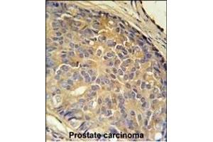 LOH12CR1 Antibody (C-term) (ABIN651991 and ABIN2840485) immunohistochemistry analysis in formalin fixed and paraffin embedded human prostate carcinoma followed by peroxidase conjugation of the secondary antibody and DAB staining.