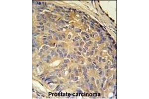 LOH12CR1 Antibody (C-term) (ABIN651991 and ABIN2840485) immunohistochemistry analysis in formalin fixed and paraffin embedded human prostate carcinoma followed by peroxidase conjugation of the secondary antibody and DAB staining. (LOH12CR1 anticorps  (C-Term))