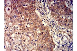 Immunohistochemical analysis of paraffin-embedded stomach cancer tissues using GRM3 mouse mAb with DAB staining.
