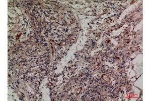 Immunohistochemistry (IHC) analysis of paraffin-embedded Human Ovary Cancer, antibody was diluted at 1:100.