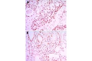 Immunohistochemical analysis of paraffin-embedded human lung cancer tissue (A) and kidney cancer tissue (B) using SIRT1 monoclonal antobody, clone 1F3  with DAB staining. (SIRT1 anticorps)
