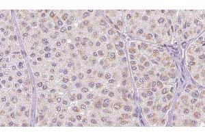 ABIN6277784 at 1/100 staining Human melanoma tissue by IHC-P. (CCL2 anticorps  (Internal Region))