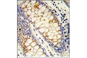 Formalin-Fixed, Paraffin-Embedded Human colon carcinoma reacted with SFRS1 Antibody (C-term), which was Peroxidase-conjugated to the secondary antibody, followed by DAB staining.