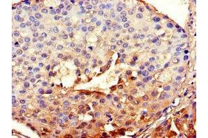Immunohistochemistry of paraffin-embedded human breast cancer using ABIN7147837 at dilution of 1:100 (Aryl Hydrocarbon Receptor Nuclear Translocator Homolog (TGO) (AA 184-302) anticorps)
