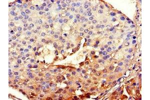 Immunohistochemistry of paraffin-embedded human breast cancer using ABIN7147837 at dilution of 1:100 (BHLHE40 anticorps  (AA 184-302))