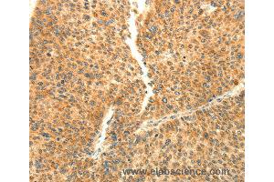 Immunohistochemistry of Human liver cancer using AARS2 Polyclonal Antibody at dilution of 1:80 (AARS2 anticorps)