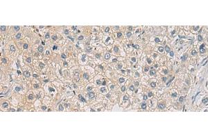 Immunohistochemistry of paraffin-embedded Human liver cancer tissue using WFDC3 Polyclonal Antibody at dilution of 1:40(x200) (WFDC3 anticorps)