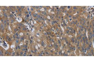 Immunohistochemistry of paraffin-embedded Human ovarian cancer using SOCS1 Polyclonal Antibody at dilution of 1:90 (SOCS1 anticorps)