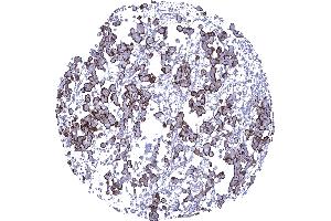Malignant mesothelioma epitheloid variant with strong predominantly membranous EMA immunostaining of tumor cells
