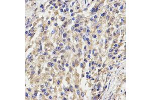 Immunohistochemistry of paraffin-embedded human lung cancer using KLRD1 antibody at dilution of 1:200 (x400 lens) (CD94 anticorps)