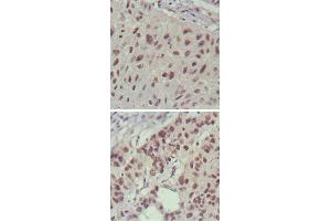 Immunohistochemical analysis of paraffin-embedded human lung cancer (upper) and cervical carcinoma (bottom) , showing nuclear localization using ISL1 monoclonal antibody, clone 1H9  with DAB staining. (ISL1 anticorps)