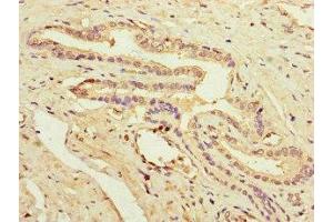 Immunohistochemistry of paraffin-embedded human prostate cancer using ABIN7162936 at dilution of 1:100 (Peroxiredoxin 2 anticorps  (AA 2-65))