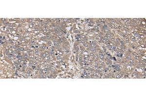 Immunohistochemistry of paraffin-embedded Human liver cancer tissue using ZFP36 Polyclonal Antibody at dilution of 1:40(x200)