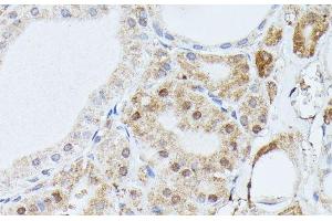 Immunohistochemistry of paraffin-embedded Human thyroid cancer using PPP2R5D Polyclonal Antibody at dilution of 1:100 (40x lens). (PPP2R5D anticorps)