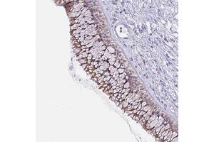 Immunohistochemical staining of human nasopharynx with PKN3 polyclonal antibody  shows moderate cytoplasmic positivity in respiratory epithelial cells. (PKN3 anticorps)
