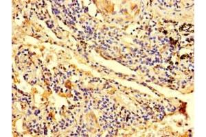 Immunohistochemistry of paraffin-embedded human lung cancer using ABIN7176377 at dilution of 1:100