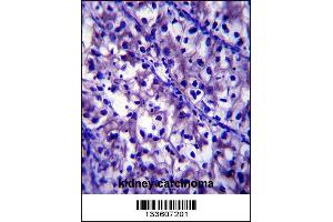 LAMB1 Antibody immunohistochemistry analysis in formalin fixed and paraffin embedded human kidney carcinoma followed by peroxidase conjugation of the secondary antibody and DAB staining. (Laminin beta 1 anticorps  (C-Term))