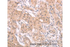 Immunohistochemistry of Human lung cancer using ADAM11 Polyclonal Antibody at dilution of 1:40 (ADAM11 anticorps)