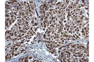 IHC-P Image PCNA antibody detects PCNA protein at nucleus in human cervical carcinoma by immunohistochemical analysis. (PCNA anticorps)