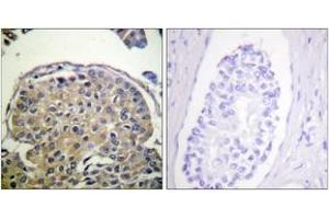 Immunohistochemistry analysis of paraffin-embedded human breast carcinoma, using CD227/Mucin 1 (Phospho-Tyr1243) Antibody. (MUC1 anticorps  (pTyr1243))